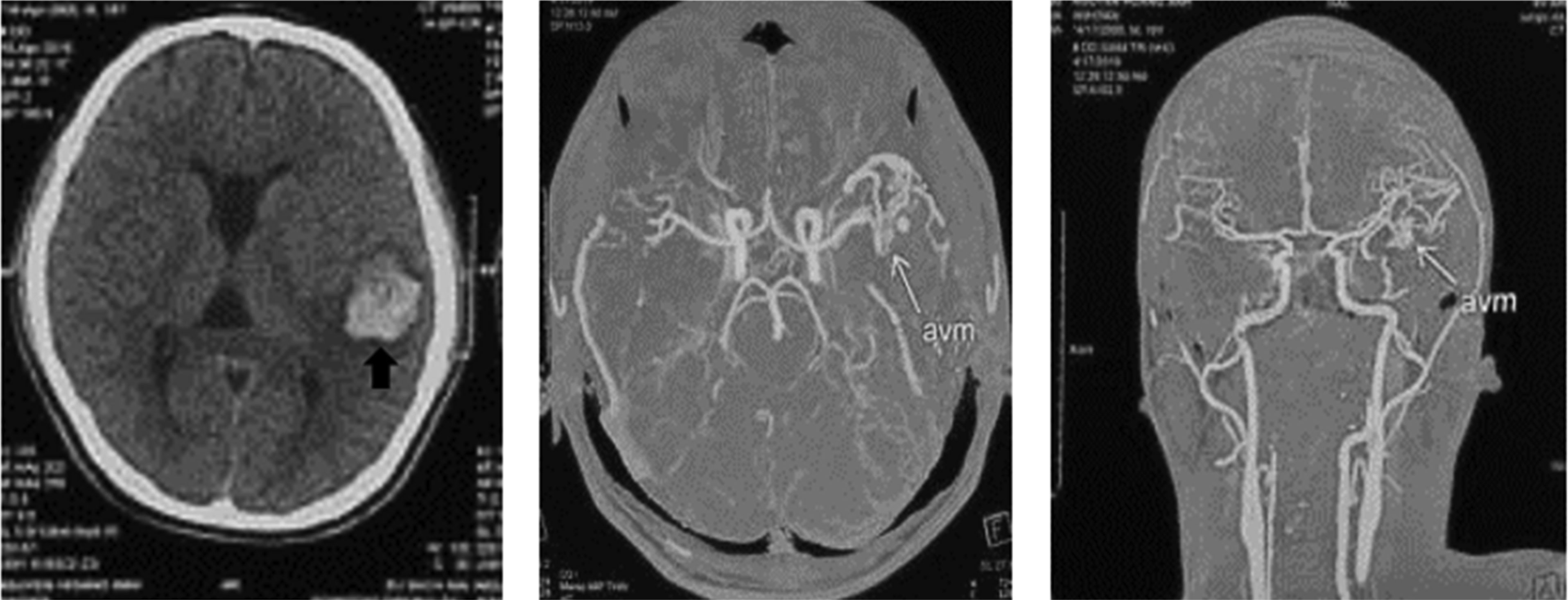 The Features Of Computed Tomography And Digital Subtraction Angiography 