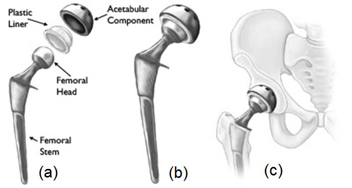 Polymeric Biomaterials for Medical Implants and Devices