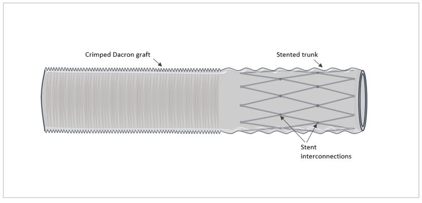 Importance of stent-graft design for aortic arch aneurysm repair