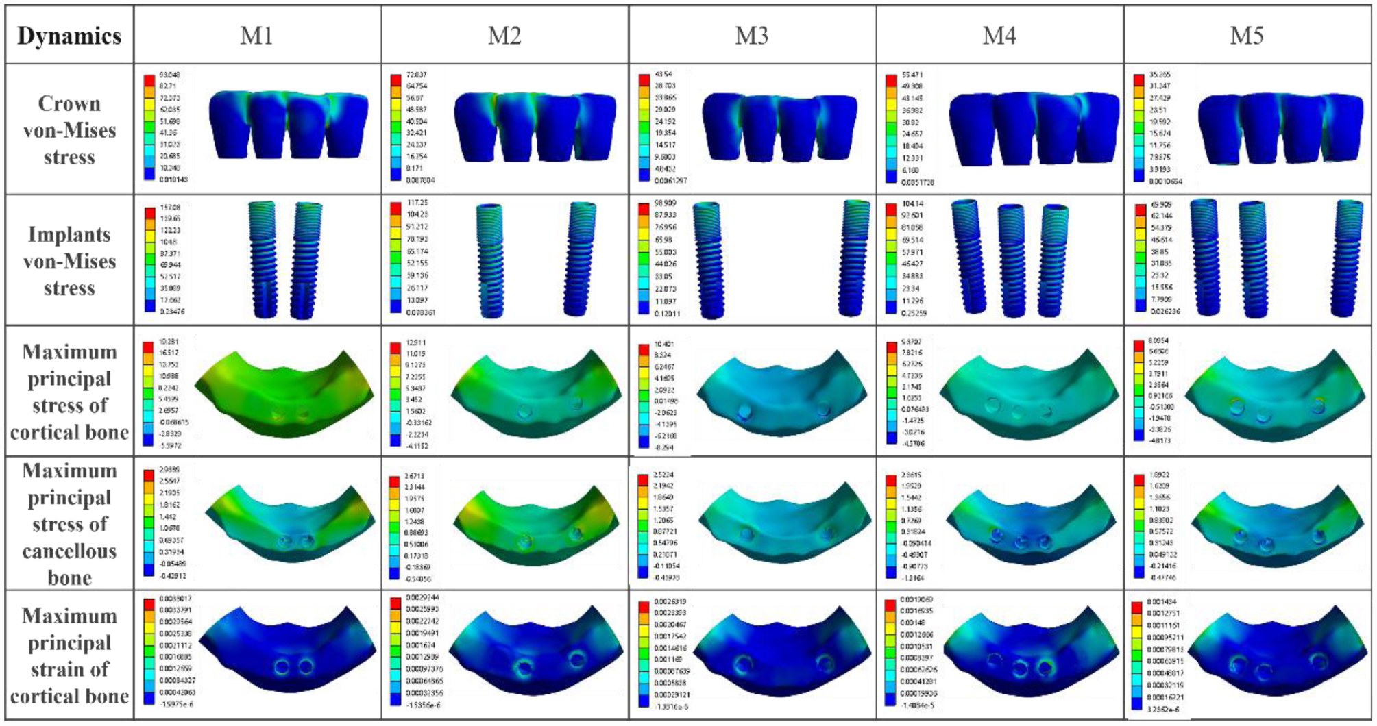 A study on the restoration strategy of a four-unit bridge in the